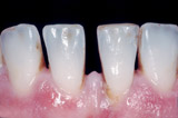 Veneers, Verblendschalen